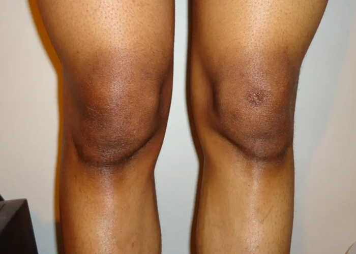 Tips Mencerahkan Lutut yang Ampuh dan Efektif
