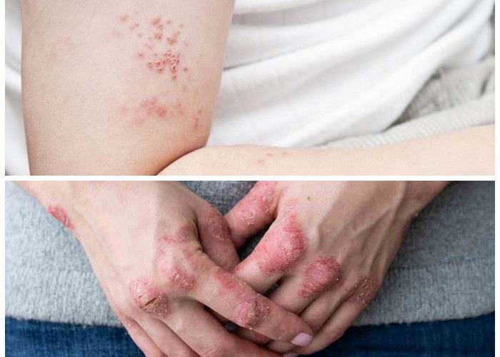 Hati-Hati! 5 Infeksi Kulit Karena Bakteri Beserta Gejala dan Penanganan Efektifnya