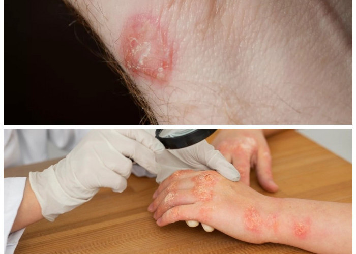 5 Infeksi Kulit Akibat Bakteri yang Sering Terjadi dan Tips Mengobatinya