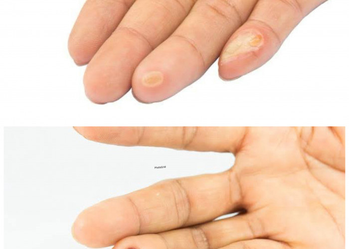 Jangan Diabaikan! Ini Penyebab Mata Ikan di Tangan dan Cara Ampuh Menghilangkannya!