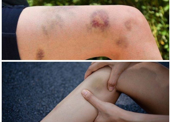 Kenali Penyebab Memar dan Ciri-Ciri Proses Penyembuhannya