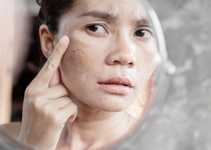 Ikuti 5 Tips Ini untuk Mengatasi Flek Hitam di Wajah 