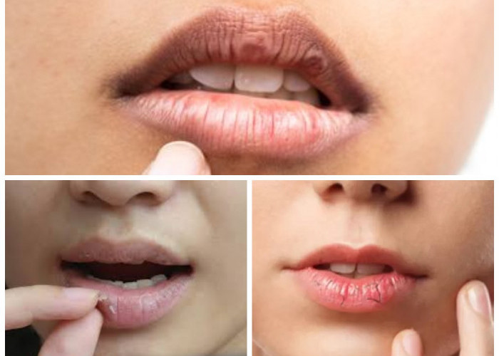 Bibir Kering, Pecah-pecah, 9 Tips Mengatasi ? Agar Bibir Kembali Lembab!