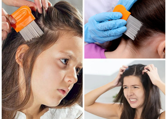 Berbagai Tips Menghilangkan Kutu Rambut dan Telurnya!