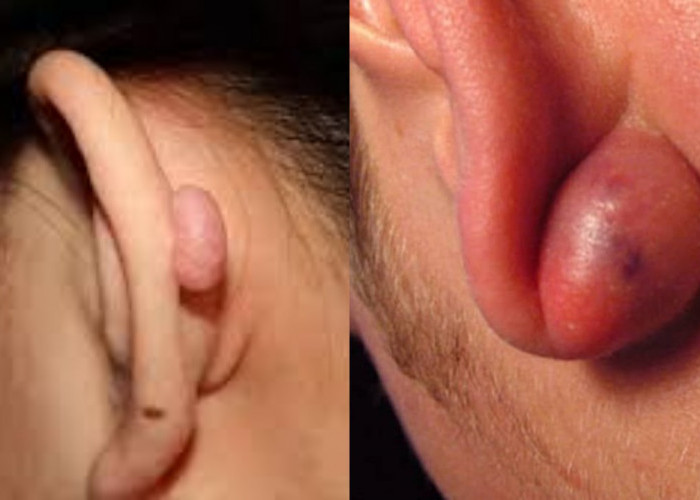 Mengenali 4 Benjolan di Daun Telinga, Ketahui Penyebab dan Langkah Penanganannya!