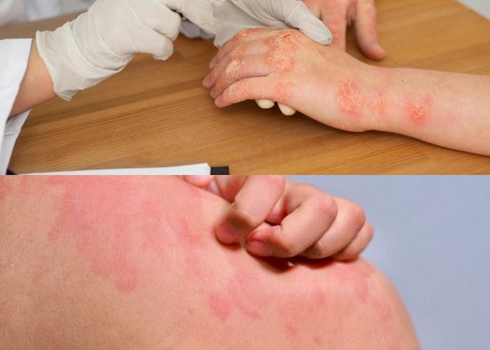 5 Tipe Infeksi Kulit Akibat Bakteri dan Cara Mengatasinya