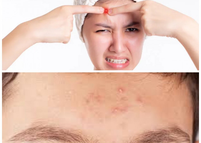 Jerawat di Dahi Tak Kunjung Hilang? Ini Penyebab dan Solusi Efektifnya