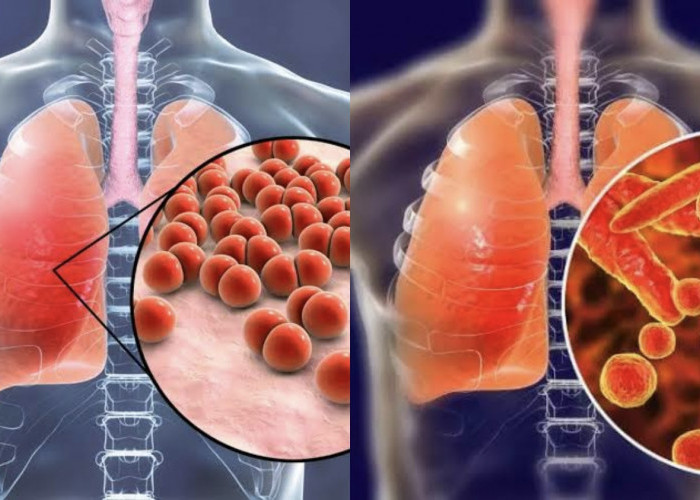 Apa Itu Pneumonia? Kenali Gejala dan Penyebabnya!