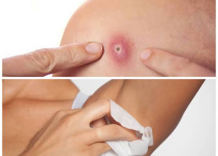 Bikin Badan Panas Dingin, Kenali 5 Penyebab Utama Bisul dan Cara Cepat Mengatasinya