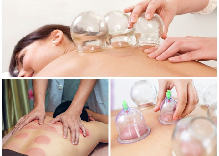 Rahasia di Balik Terapi Bekam di Kepala: Antara Manfaat dan Risiko Kesehatan!