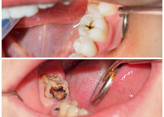 Cara Alami Mengatasi Gigi Berlubang: Solusi Praktis Tanpa Perlu ke Dokter