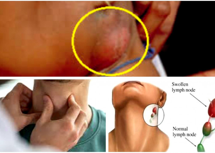 Getah Bening Langsung Kempes. Lakukan Langkah-langkah Pengobatan Ini