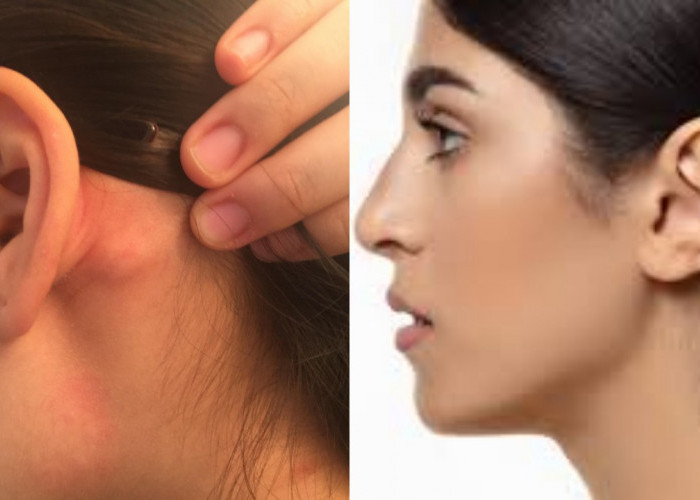 Jangan Khawatir Bila Muncul Benjolan di Daun Telinga ini Tips Cara Ampuh Mengatasinya?