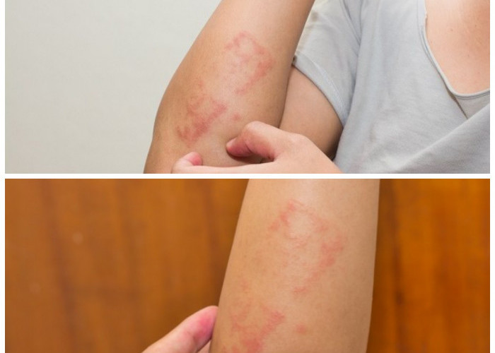 Gejala Alergi Jamur yang Sering Diabaikan dan Cara Efektif Mengatasinya