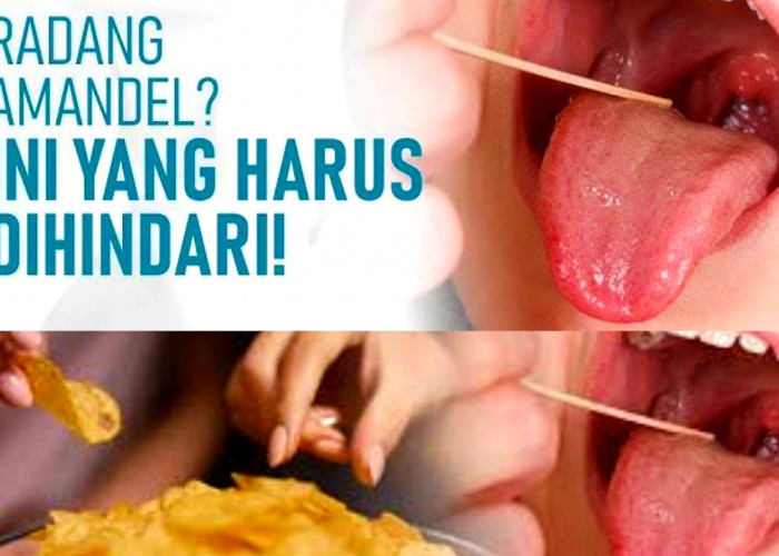 Awas Makin Parah! Penderita Amandel Wajib Hindari 5 Makanan Ini