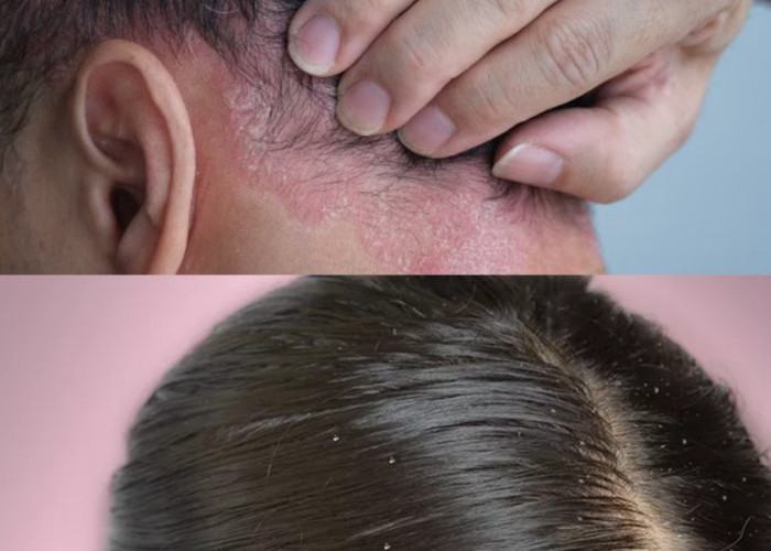 Sama-sama Menimbulkan Gatal, Berikut Perbedaan antara Ketombe dan Dermatitis Seboroik