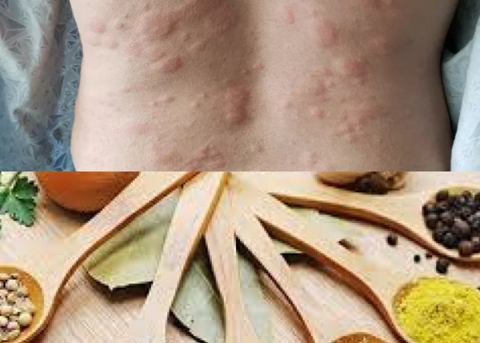  Obat Biduran Alami yang Ampuh dari Bahan Herbal Yang Wajib Tahu!