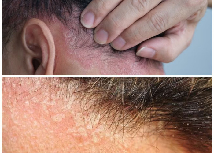 Ketombe vs Dermatitis Seboroik: Kenali Perbedaan, Penyebab, dan Cara Mengatasinya