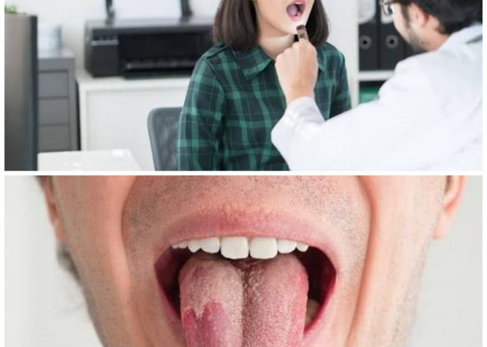 8 Langkah Efektif Meredakan Radang Lidah (Glossitis) Secara Tepat
