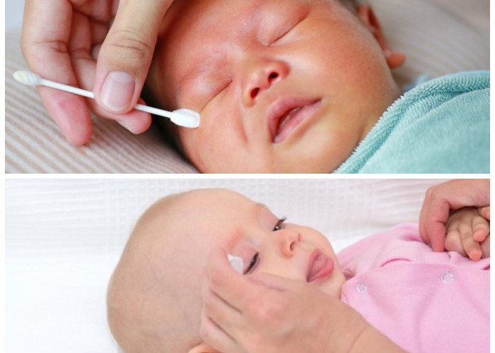 Mengenal Bayi Belekan: Apakah Ini Kondisi yang Perlu Dikhawatirkan?