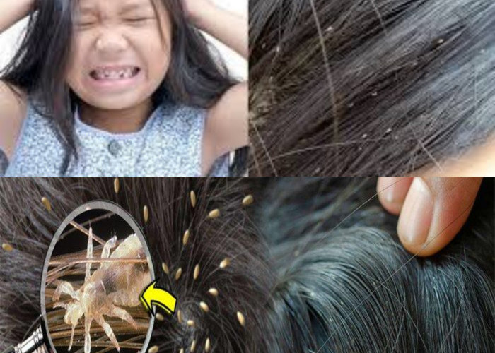  Inilah Rekomendasi Obat Kutu Rambut Terbaik!