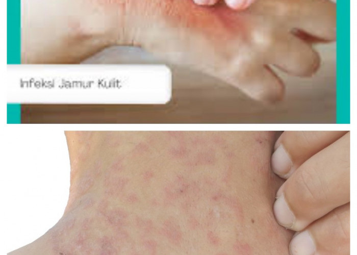 Waspadai Alergi Jamur, Ini Gejala yang Muncul serta Pilihan Pengobatannya