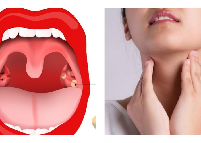 Kenali Penyebab Batu Amandel dan Cara Mengatasinya