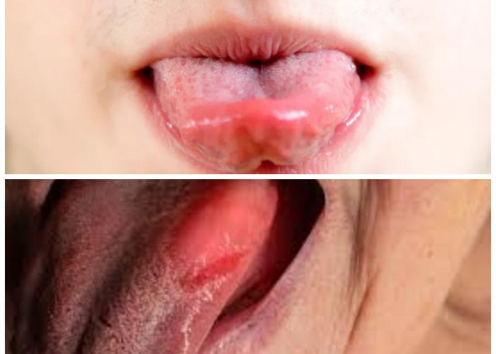 Tips Ampuh Meredakan Radang Lidah Agar Aktivitas Sehari-hari Tidak Terganggu