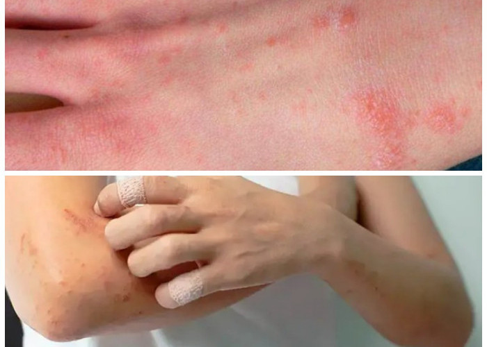 Kenali Infeksi Kulit Bakteri: Dari Tanda Awal hingga Penanganan Tepat