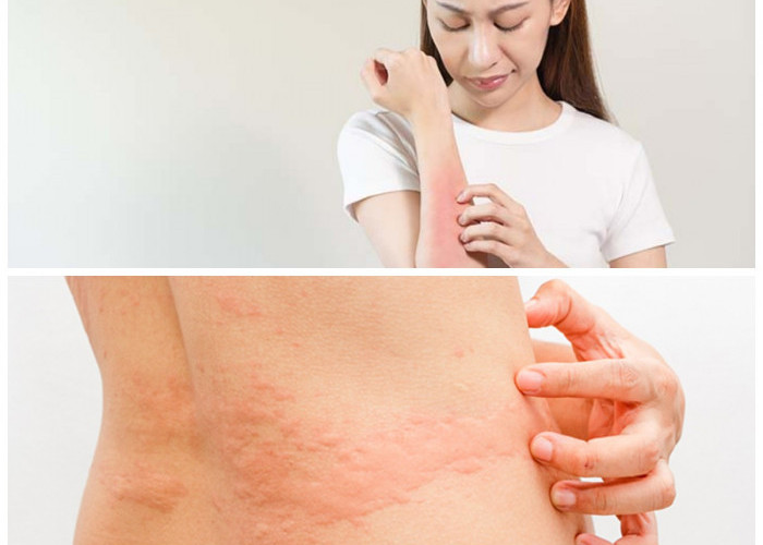 Obat Biduran dari Bahan Alami: Solusi Herbal untuk Gatal dan Ruam