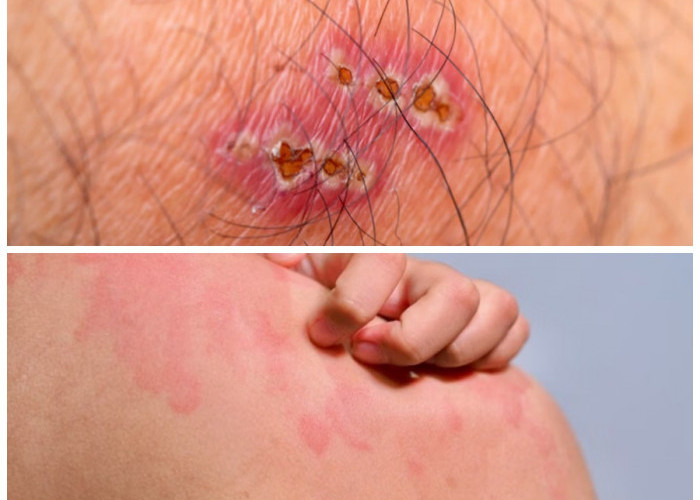 Kenali 5 Jenis Infeksi Kulit karena Bakteri Lengkap dengan Cara Penanganannya