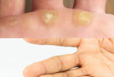  Mata Ikan di Tangan, Pahami Alasan dan Metode untuk Menyingkirkannya