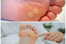Sering Mengganggu Aktivitas? Ini 5 Tips Ampuh Mengatasi Mata Ikan di Tangan Sampai Tuntas!