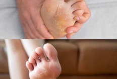 Kembali Mulus Bebas Gatal! Ini Cara Ampuh Mengatasi Kulit Kaki Pecah-Pecah dan Mengelupas
