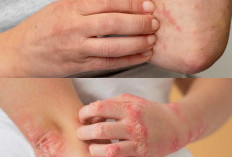 Yuk Wajib Anda Ketahui! Gigitan Kutu Kucing pada Manusia, Pahami Tanda dan Solusi Menghadapinya