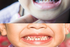 Jangan Anggap Sepele! Ini 3 Dampak Buruk Karies Gigi pada Anak yang Bisa Mengganggu Tumbuh Kembangnya