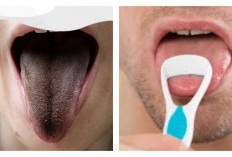 5 Penyebab Lidah Tampak Hitam dan Berbulu
