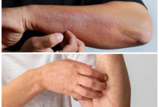 Jangan Diabaikan, Ini 8 Penyebab Kulit Kering dan Gatal yang Berkaitan dengan Kesehatan