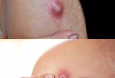  Ini 5 Penyebab Munculnya Bisul pada Kulit yang Perlu Diwaspadai Yang Mebuat panas Dingin Dibadan!