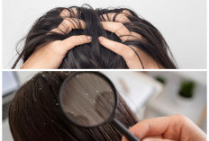 Sering Disamakan, Ini Perbedaan Ketombe dan Dermatitis Seboroik yang Perlu Diketahui
