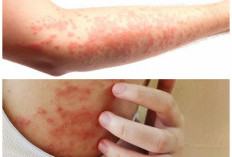 Wajib Tahu! 7 Jenis Penyakit Kulit Beserta Cara Mengatasinya Secara Tepat