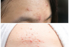 Cara Ampuh Atasi Jerawat di Jidat: Kenali Penyebab dan Tips Menghilangkannya