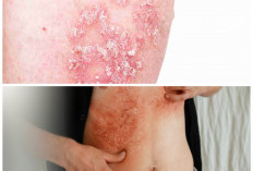 Jangan Abaikan! Ini 7 Penyakit Kulit yang Sering Terjadi dan Cara Penanganannya