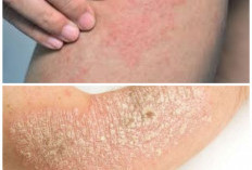 Waspada! Kulit Kering dan Gatal Bisa Menjadi Sinyal 8 Penyakit Serius Ini