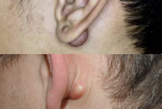 4 Metode untuk Mengatasi Benjolan di Belakang Telinga
