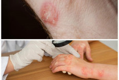 5 Infeksi Kulit Akibat Bakteri yang Sering Terjadi dan Tips Mengobatinya