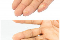 Jangan Diabaikan! Ini Penyebab Mata Ikan di Tangan dan Cara Ampuh Menghilangkannya!