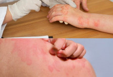 5 Tipe Infeksi Kulit Akibat Bakteri dan Cara Mengatasinya