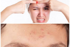 Jerawat di Dahi Tak Kunjung Hilang? Ini Penyebab dan Solusi Efektifnya