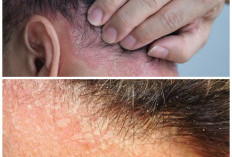 Ketombe vs Dermatitis Seboroik: Kenali Perbedaan, Penyebab, dan Cara Mengatasinya